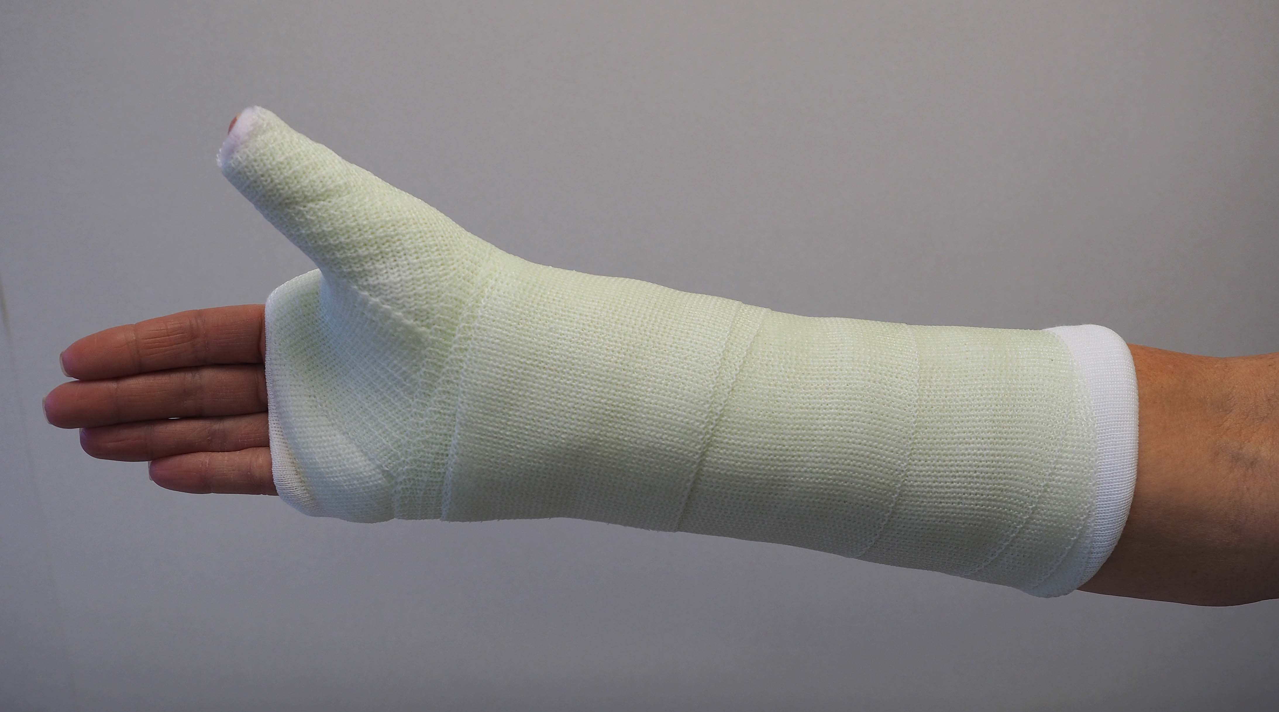 Spica Cast for Scaphoid Fracture