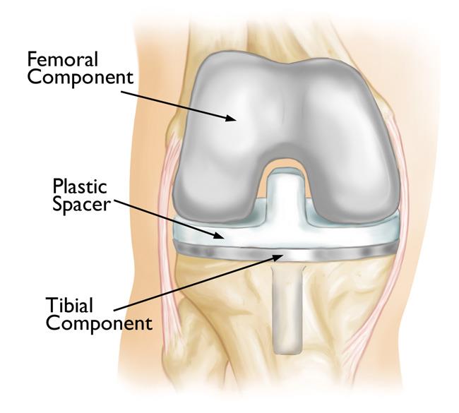 A total knee replacement implant. 