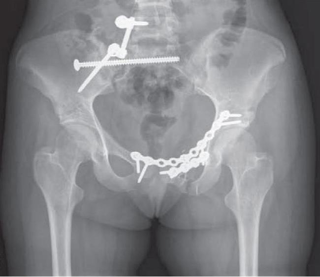 Internal fixation of pelvic fracture