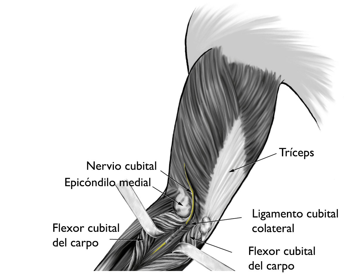 Esta ilustración muestra la ruta del nervio cubital a través del túnel cubital. También se muestran las estructuras que pueden comprimir el nervio, como el epicóndilo medial y el ligamento colateral cubital. 