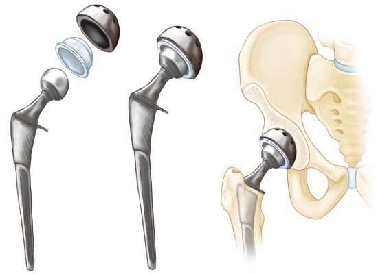 HANZE 1/3 Scale Artificial Hip Joint Replacement Skeleton Model – Medical Anatomical Demo For Education