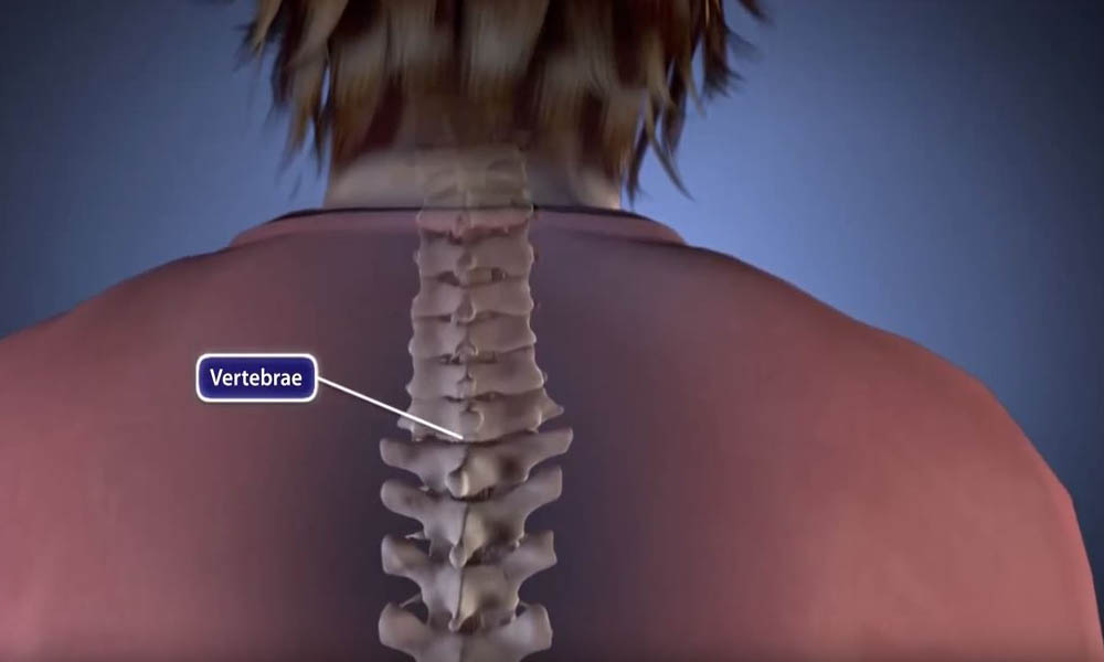 Spinal Fusion Procedure Animation - OrthoInfo -AAOS