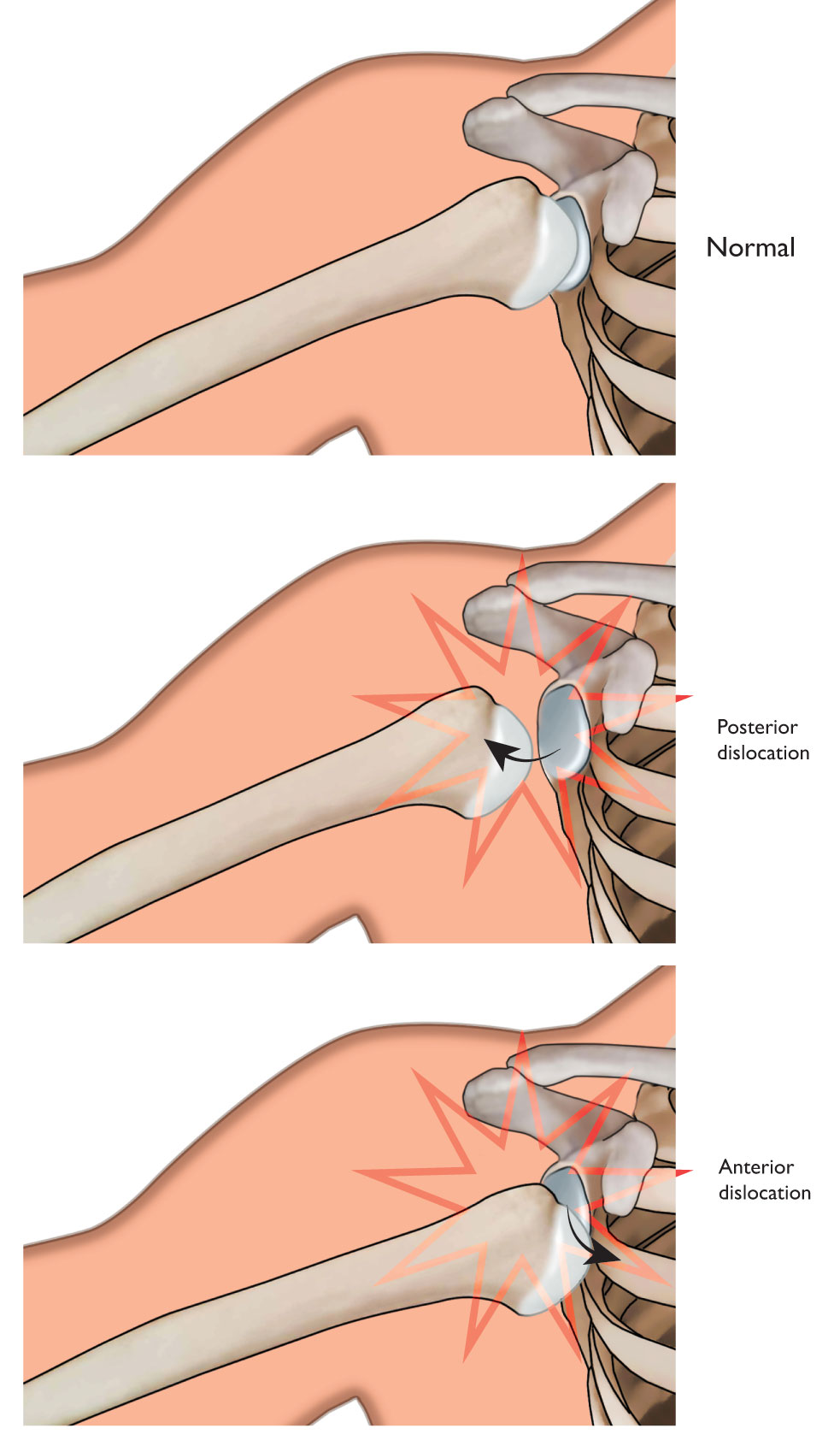 Illustration Showing Normal Shoulder Anatomy, Posterior Dislocation, and Anterior Dislocation