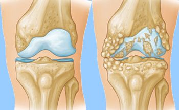 Arthritis of the Knee - OrthoInfo - AAOS