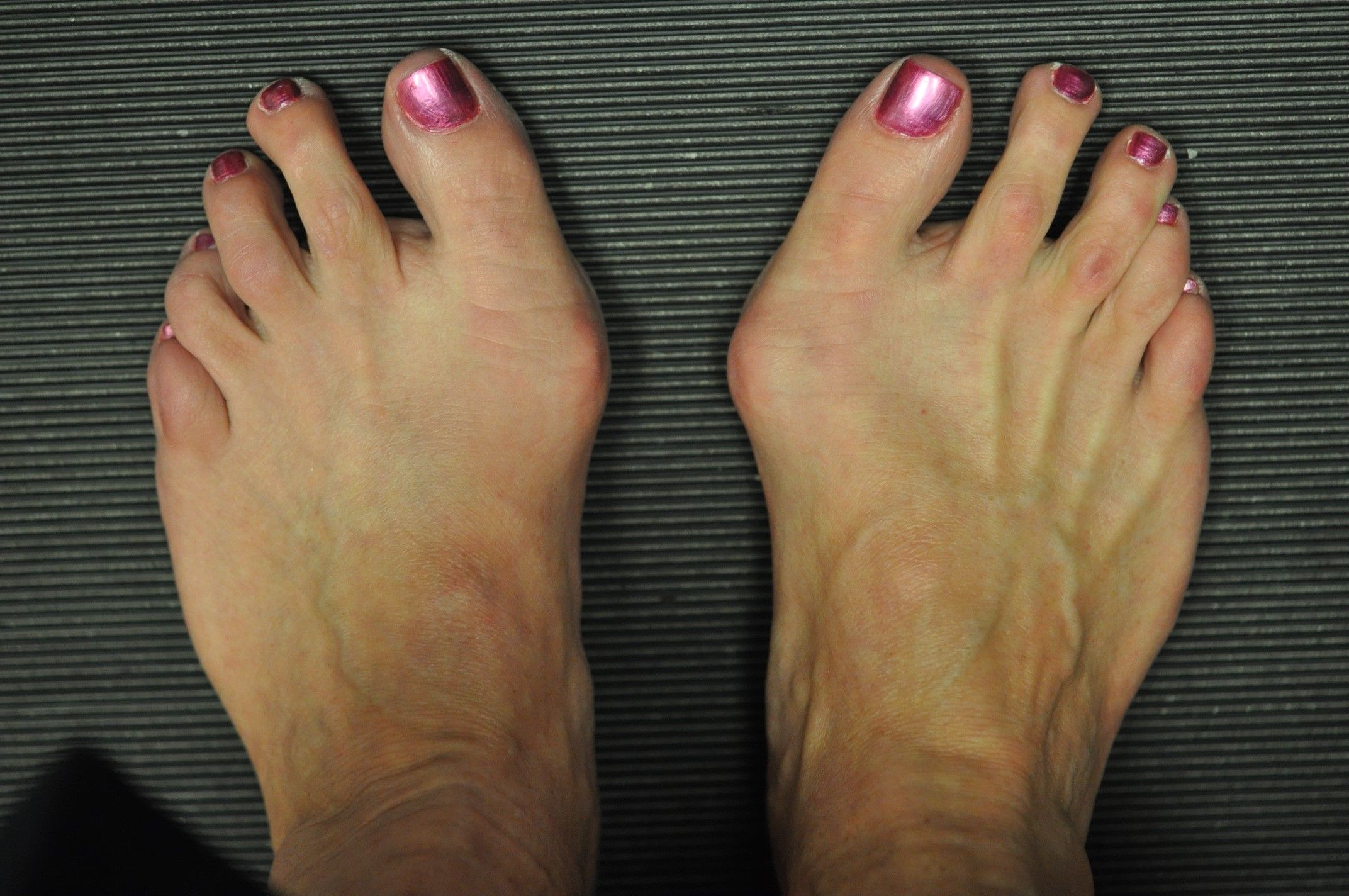 bunions on heels of feet