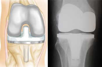 Total Knee Replacement - OrthoInfo - AAOS