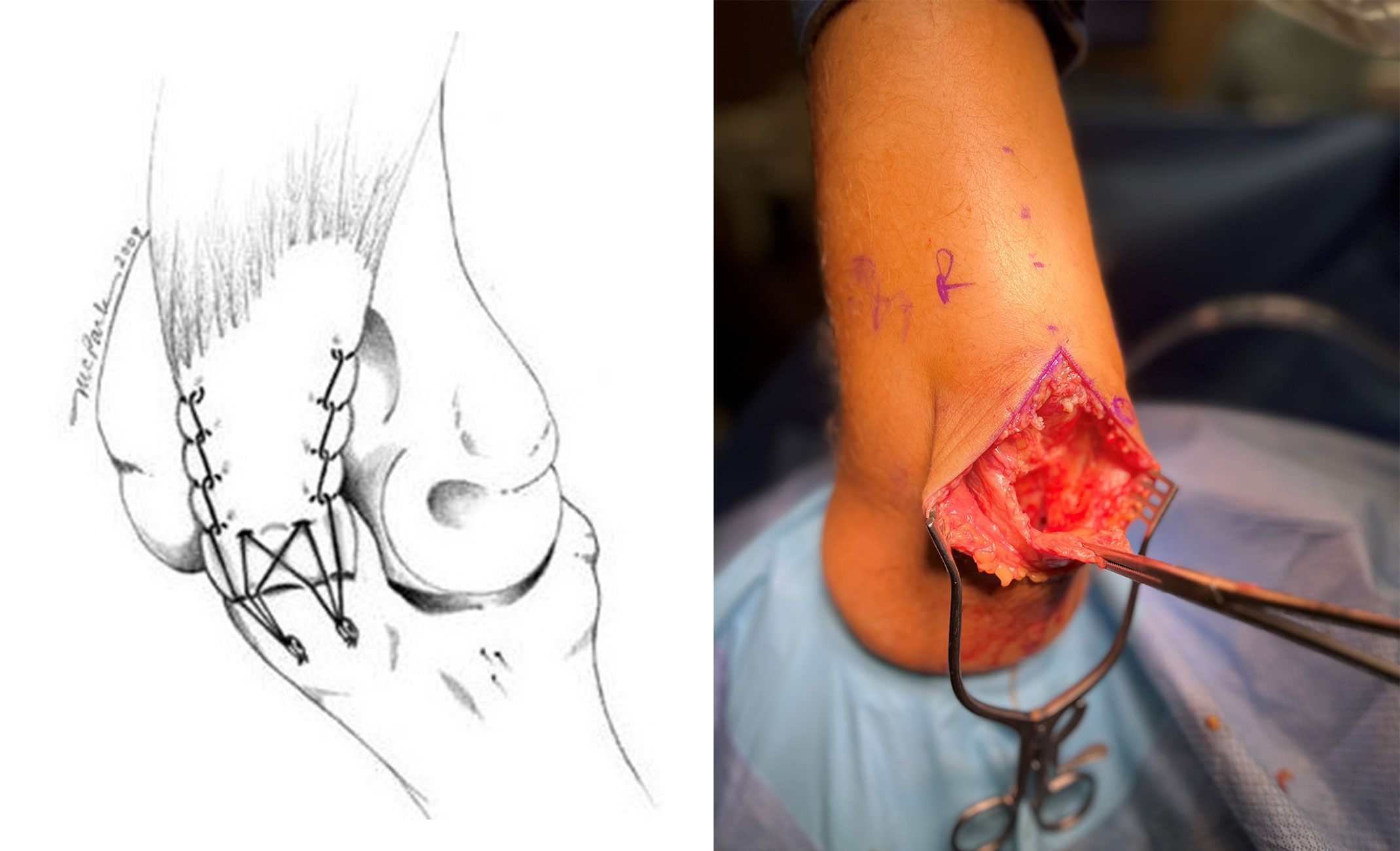 Illustration and Photo Showing Triceps Tendon Tear at Elbow Repair Surgery