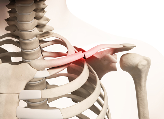 Clavicle Fracture (Broken Collarbone) - OrthoInfo - AAOS