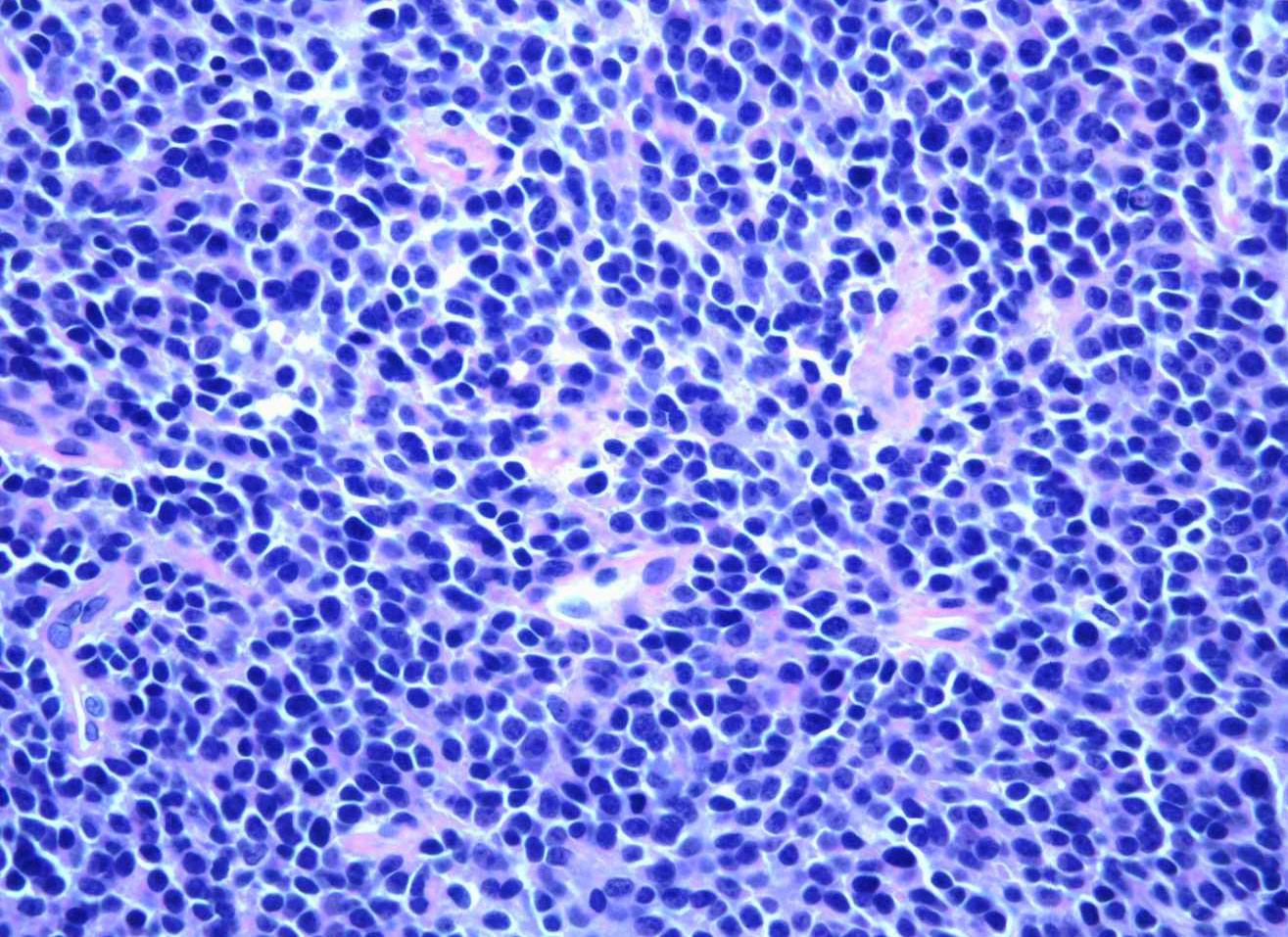 El sarcoma de Ewing al microscopio