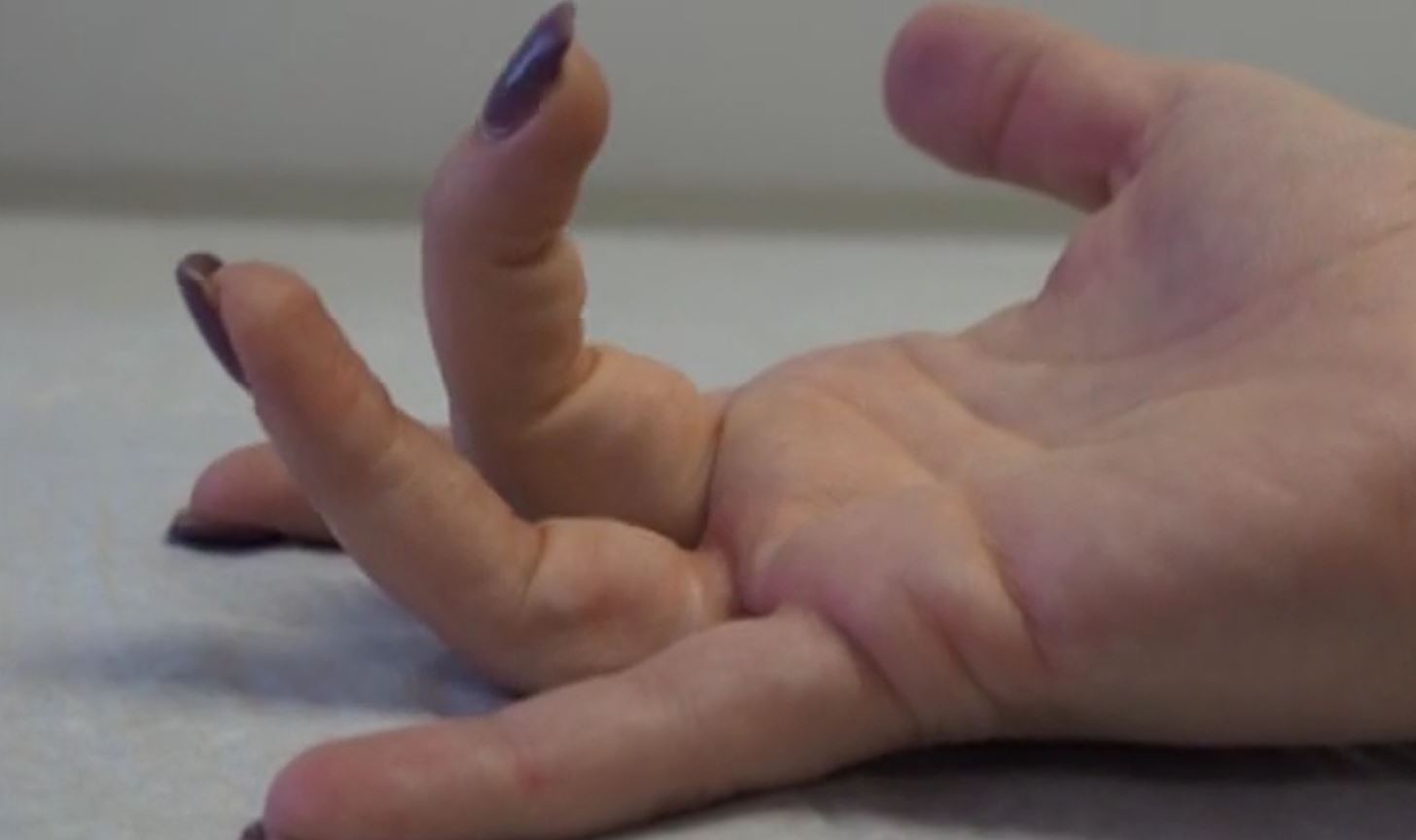 Photo of person with trigger finger