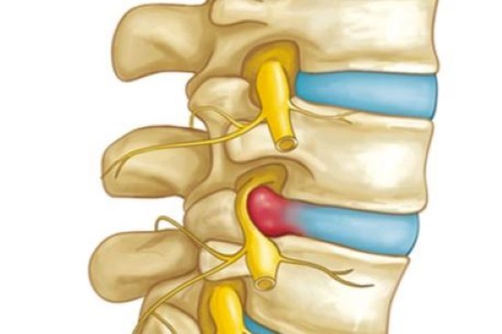 Hernia de disco en la columna Disk in the Lower Back) - OrthoInfo - AAOS