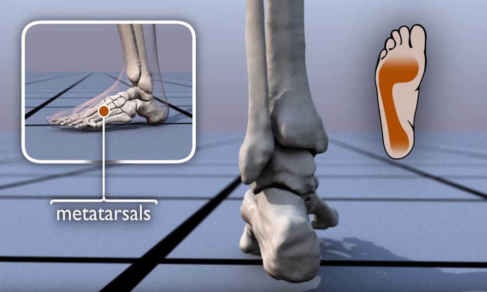 Walking and Pronation Animation - OrthoInfo -AAOS