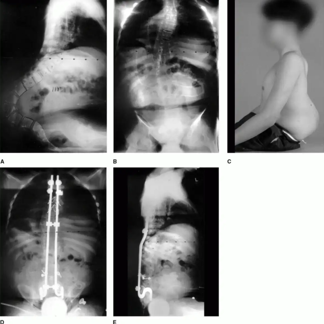 surgery for child with myelomeningcele and kyphosis