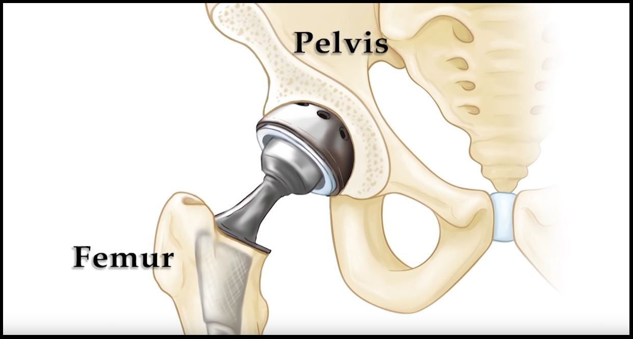 Dislocation After Hip Replacement Orthoinfo Aaos