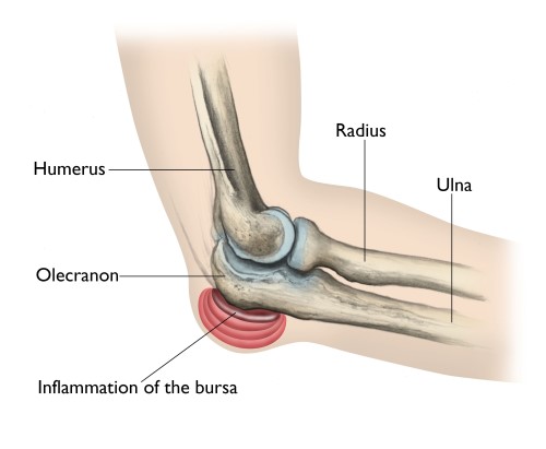 Elbow (Olecranon) Bursitis - OrthoInfo - AAOS
