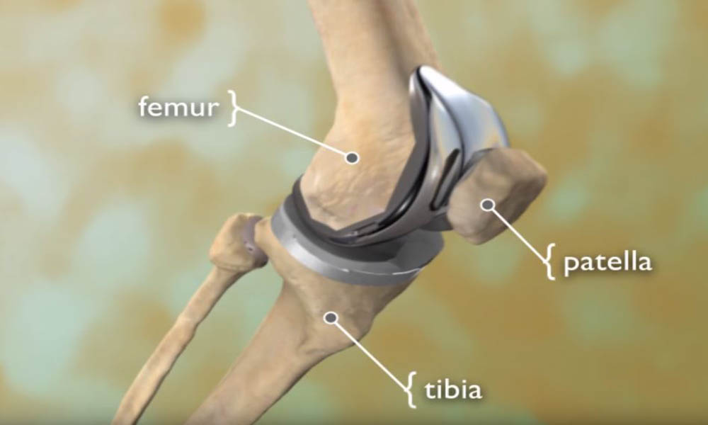 knee joint replacement devices