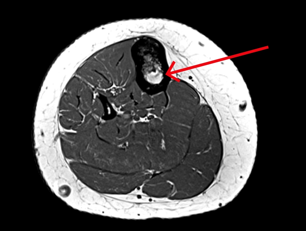 Adamantinoma in tibia