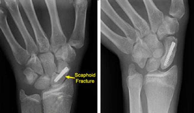 Internal fixation of scaphoid fracture