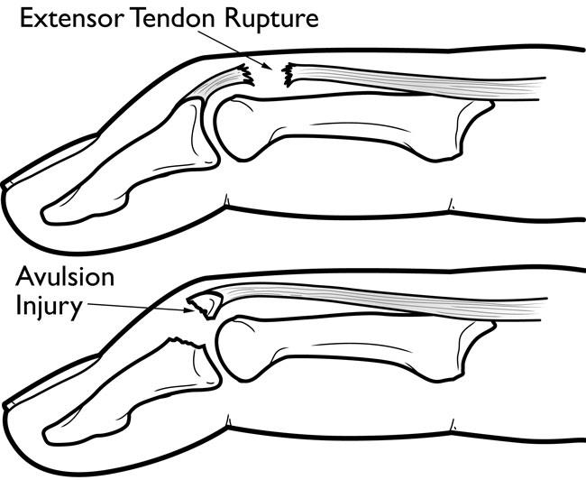 Extensor tendon rupture