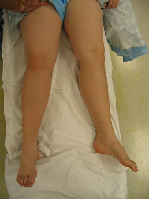 Clinical photo of patient with SCFE