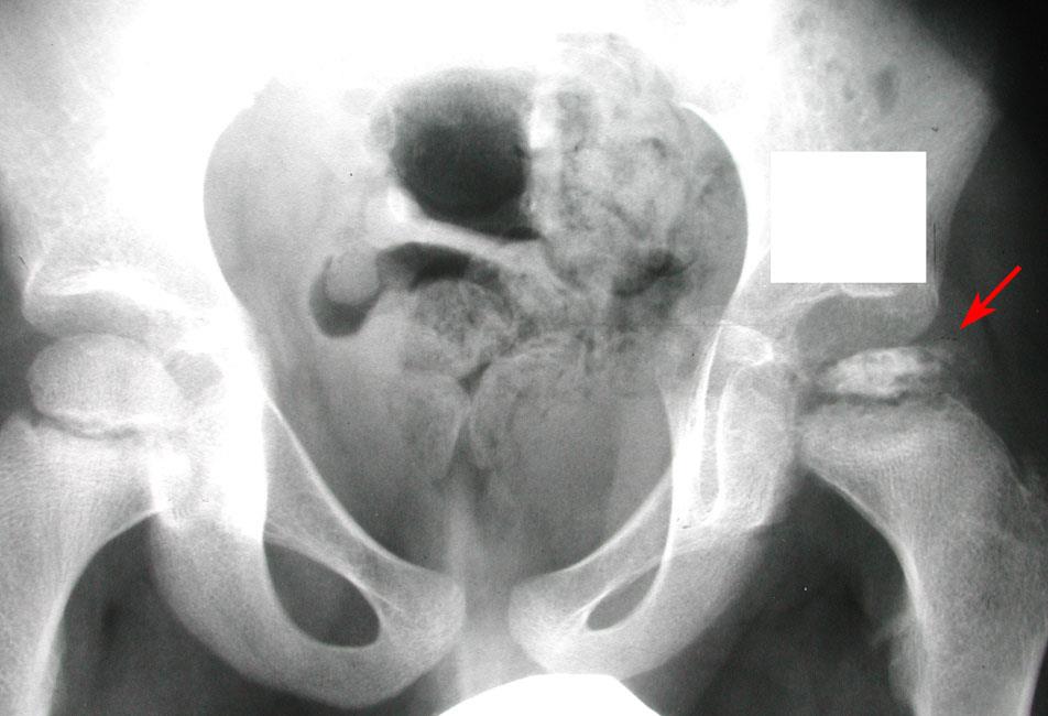 Collapse of femoral head