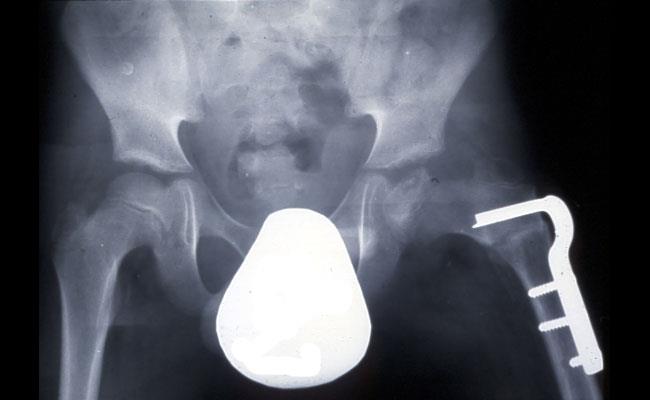X-ray after osteotomy