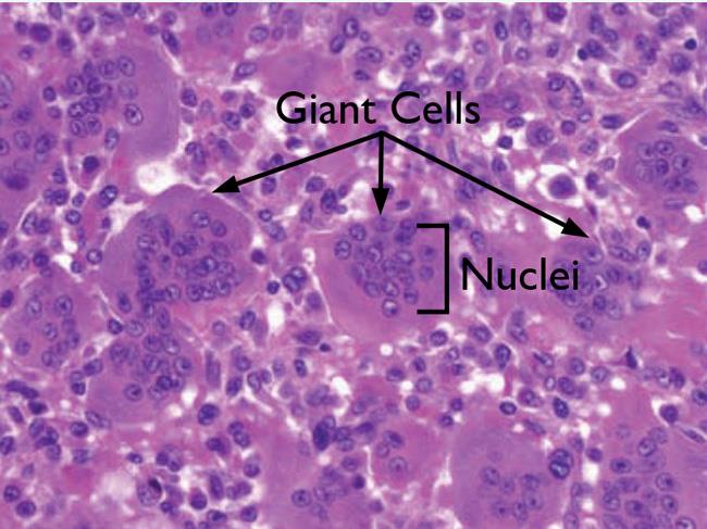Microscope view of giant cell tumor