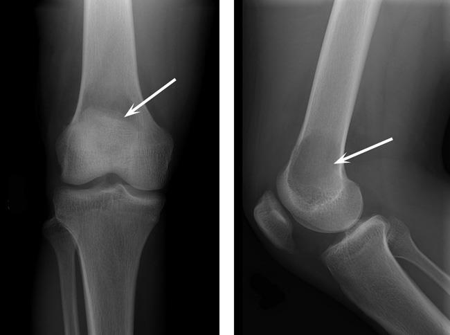 X-rays of giant cell tumor