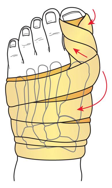 Dressing applied to foot after osteotomy