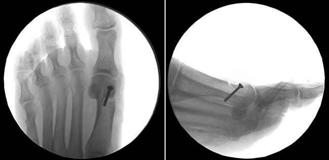 Foot x-rays showing a bunion corrected with osteotomy