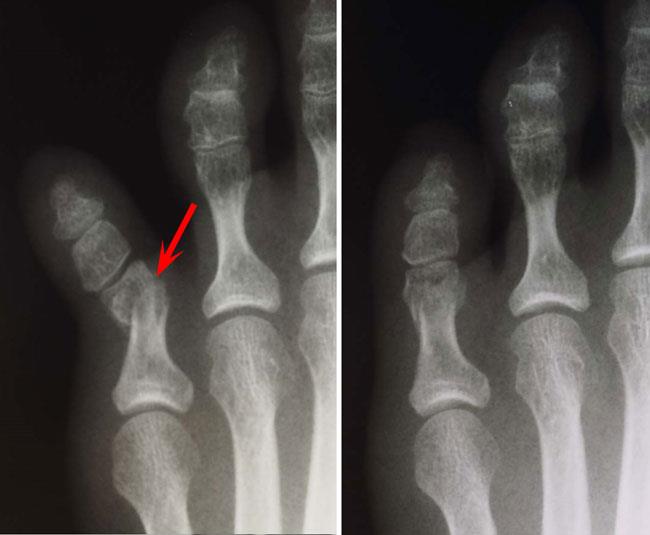 Proximal phalanx fracture of the fifth toe