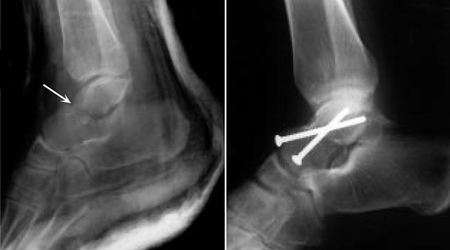 Internal fixation of talus fracture