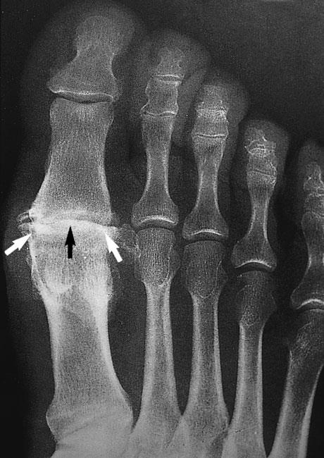 x-ray of osteoarthritis of the metatarsophalangeal joint of the big toe