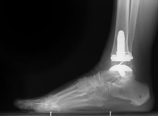 An x-ray of a total ankle replacement (arthroplasty) 