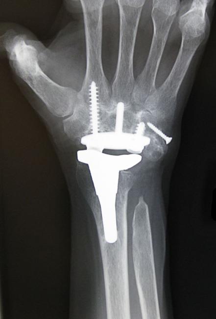 X-ray of total wrist replacement (arthroplasty) 