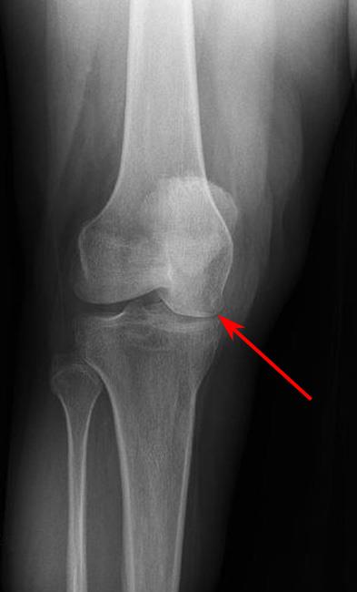 Narrowing of the joint space in the knee