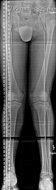 Scanogram showing leg length discrepancy