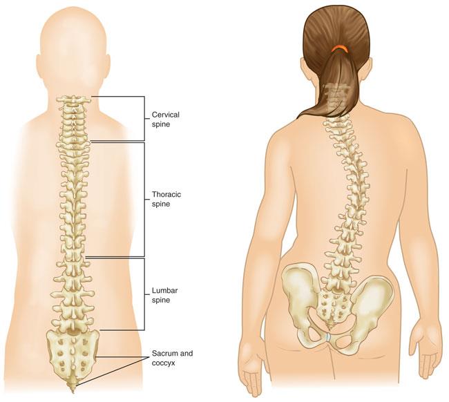 Illustrations of a normal spine and a spine with scoliosis
