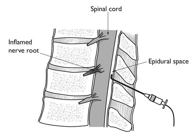 Illustration of an epidural injection in the cervical spine. 