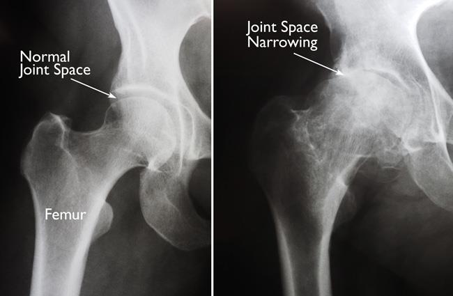 x-rays of normal hip and hip with arthritis