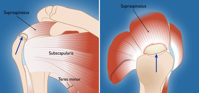 Front and overhead view of a full-thickness tear in the supraspinatus tendon