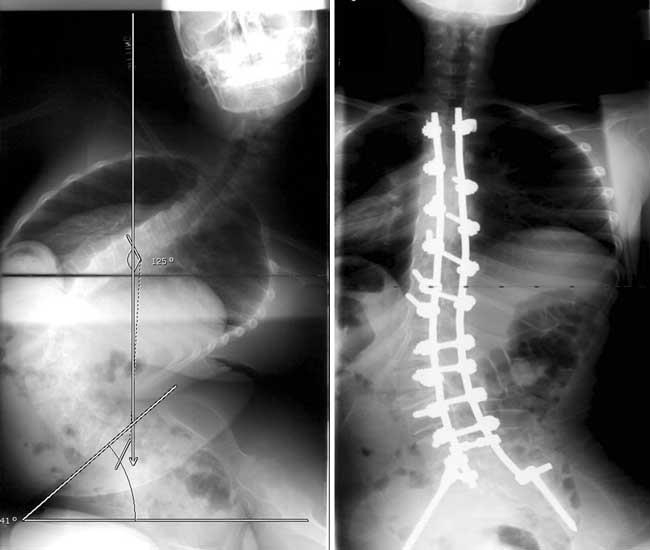 X-rays of a spinal curve before and after treatment with spinal fusion
