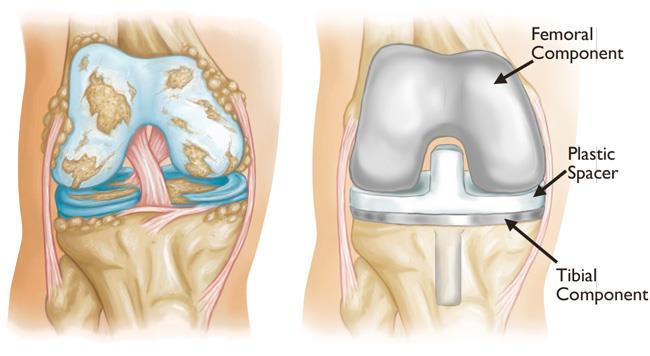 illustrations of severe osteoarthritis and knee replacement