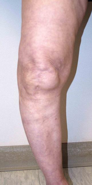 A knee that has become bowed as a result of severe arthritis. 