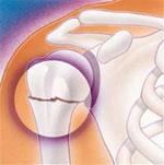 Fractured Head of the Humerus
