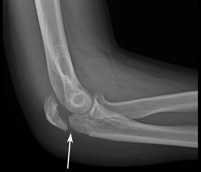 X-ray of displaced olecranon fracture