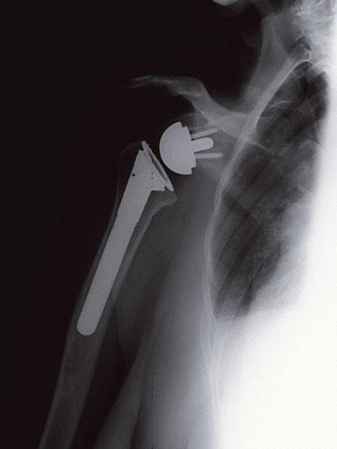 X-ray showing reverse total shoulder replacement