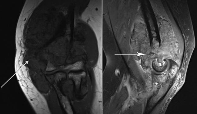 MRI scans of an elbow with PVNS