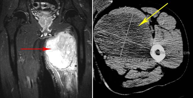 MRI and CT scan of a soft tissue sarcoma