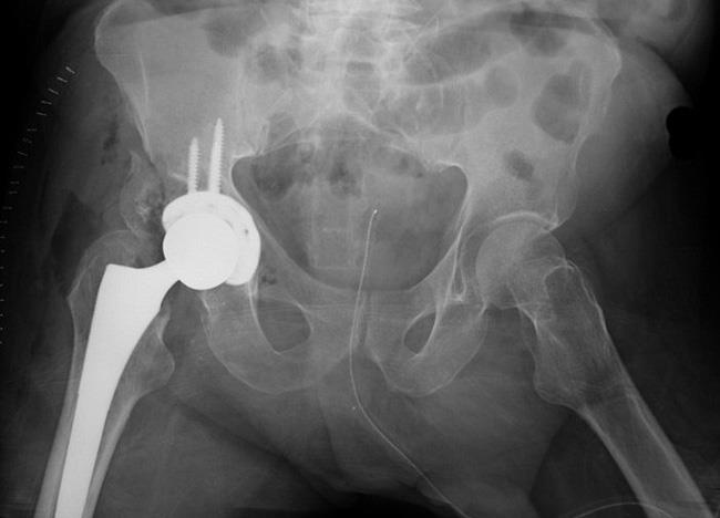 X-ray of total hip replacement after acetabular fracture